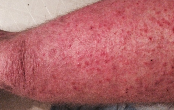 Skin Aflame – A Poem and an&nbsp;Abstract